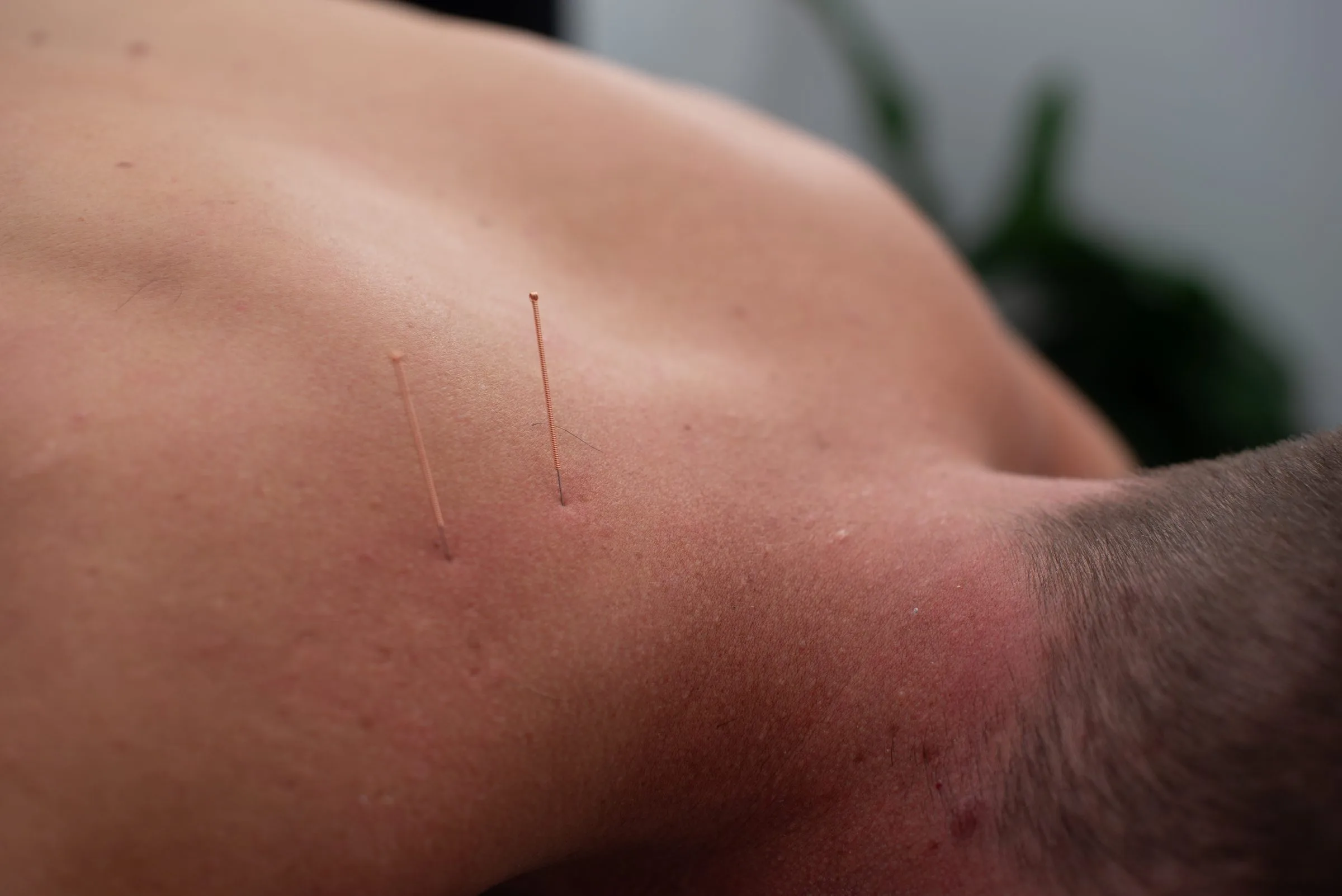 Practitioner placing dry needles in a patient's muscle